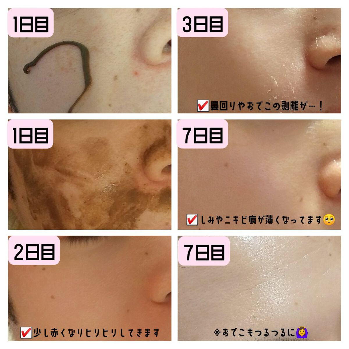 ダーマスキンピーリング|BQCELLの使い方を徹底解説 - 🌿自宅 ダーマスキンピーリング|BQCELLの使い方を徹底解説 - 🌿自宅