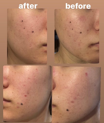 AZアゼライン酸10セラム/コスデバハ/美容液を使ったクチコミ(1枚目)