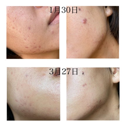 N10+Z1フェイスセラム /The Ordinary/美容液を使ったクチコミ(7枚目)