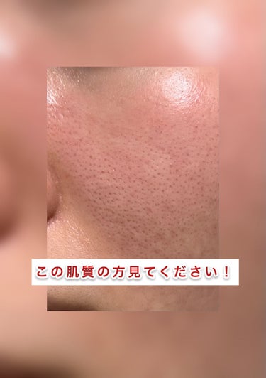 Cure スペシャルパウダーソープCureのクチコミ「私と同じ肌質で皮膚科に行ってもニキビが治らないっていう方に見てほしいです！！！

✼••┈┈•.....」（1枚目）