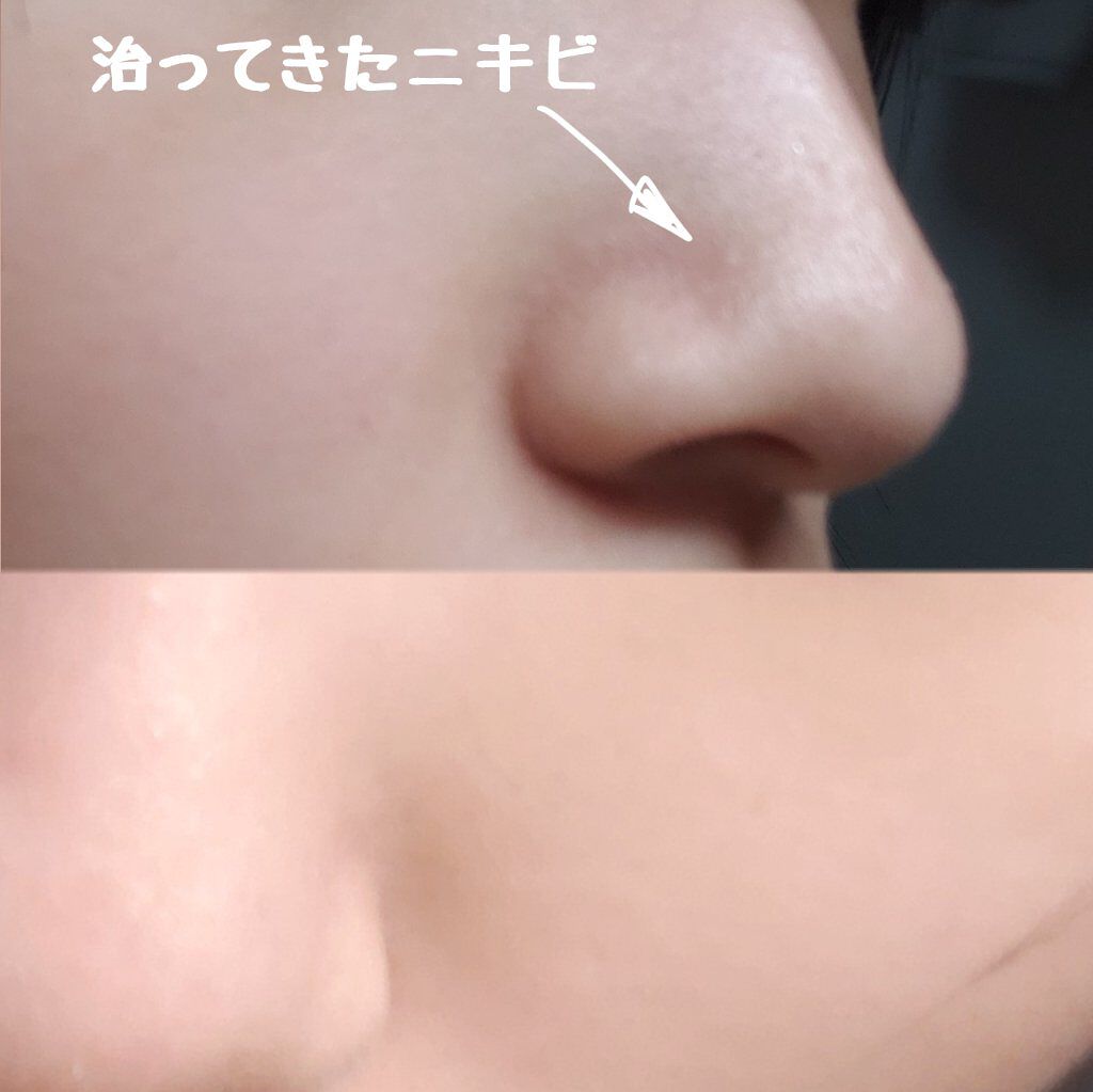 ピンクティーツリートナー/APLIN/化粧水を使ったクチコミ(2枚目)