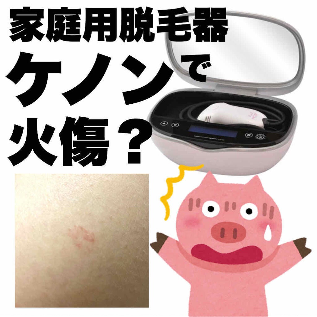 光美容器KE-NON(ケノン)|エムテックの使い方を徹底解説 - 雨 光美容器KE-NON(ケノン)|エムテックの使い方を徹底解説 - 雨