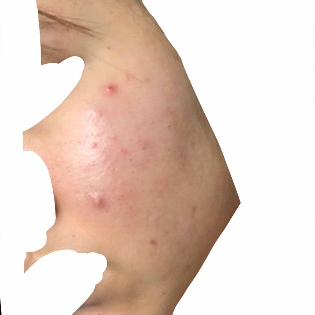 さき on LIPS 「ニキビ、ニキビ跡がすごいです。どうすればいいでしょうか😢また、..」(4枚目)