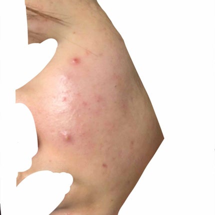 さき on LIPS 「ニキビ、ニキビ跡がすごいです。どうすればいいでしょうか😢また、..」(4枚目)