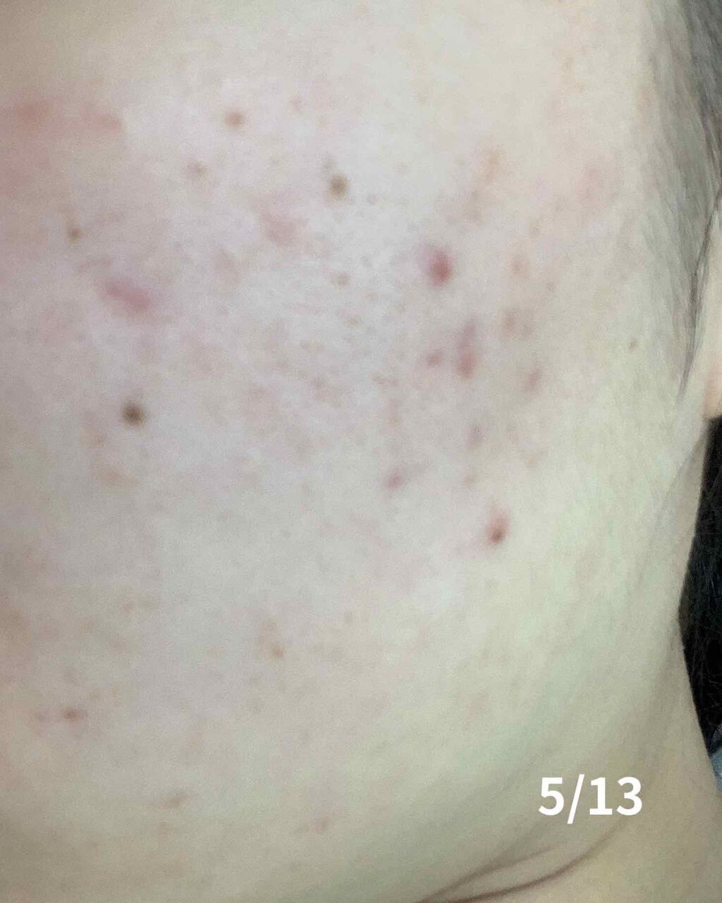 薬用 しみ 集中対策 美容液/メラノCC/美容液を使ったクチコミ（2枚目）