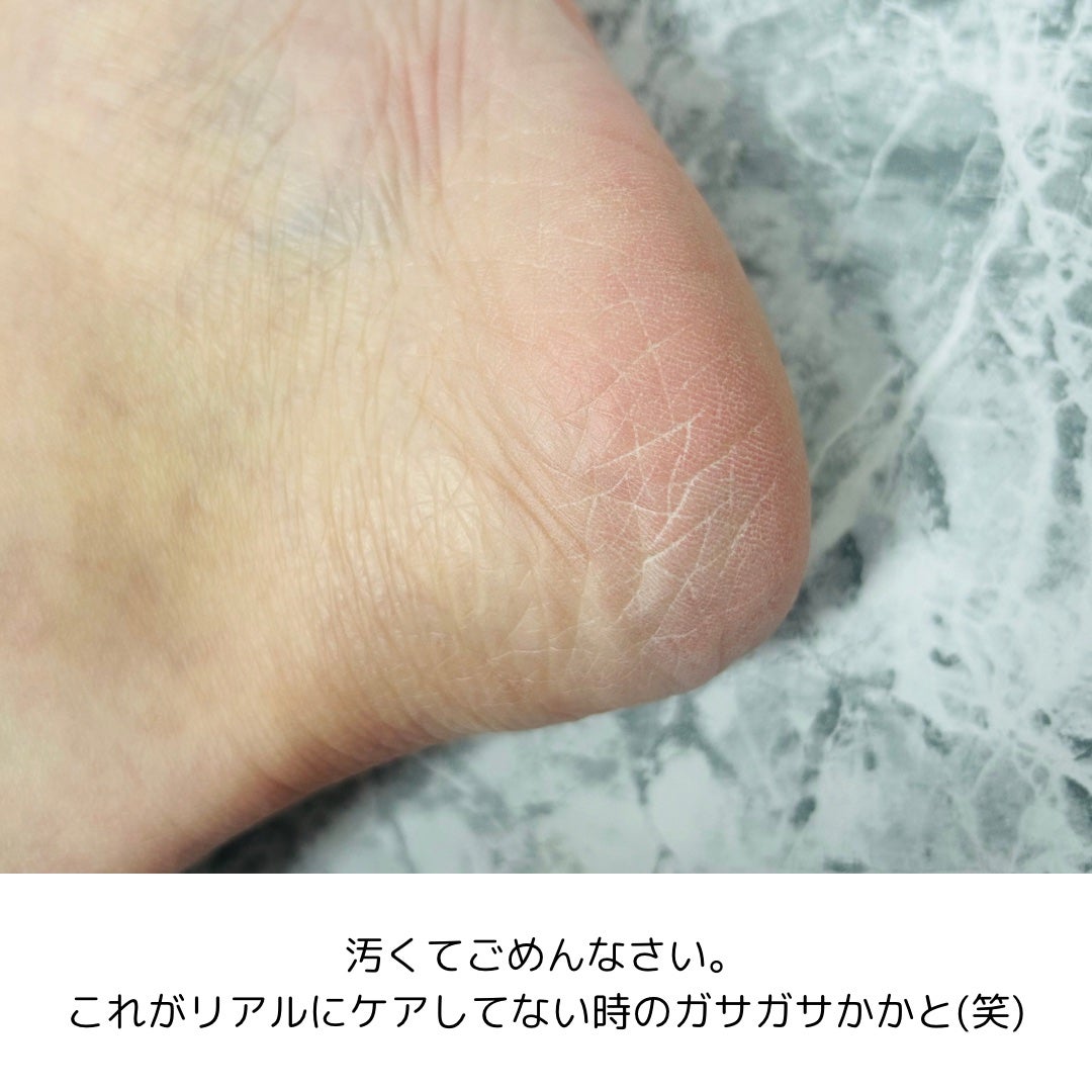 かかとピーリングマスク/ドクター・ショール/レッグ・フットケアを使ったクチコミ(5枚目)