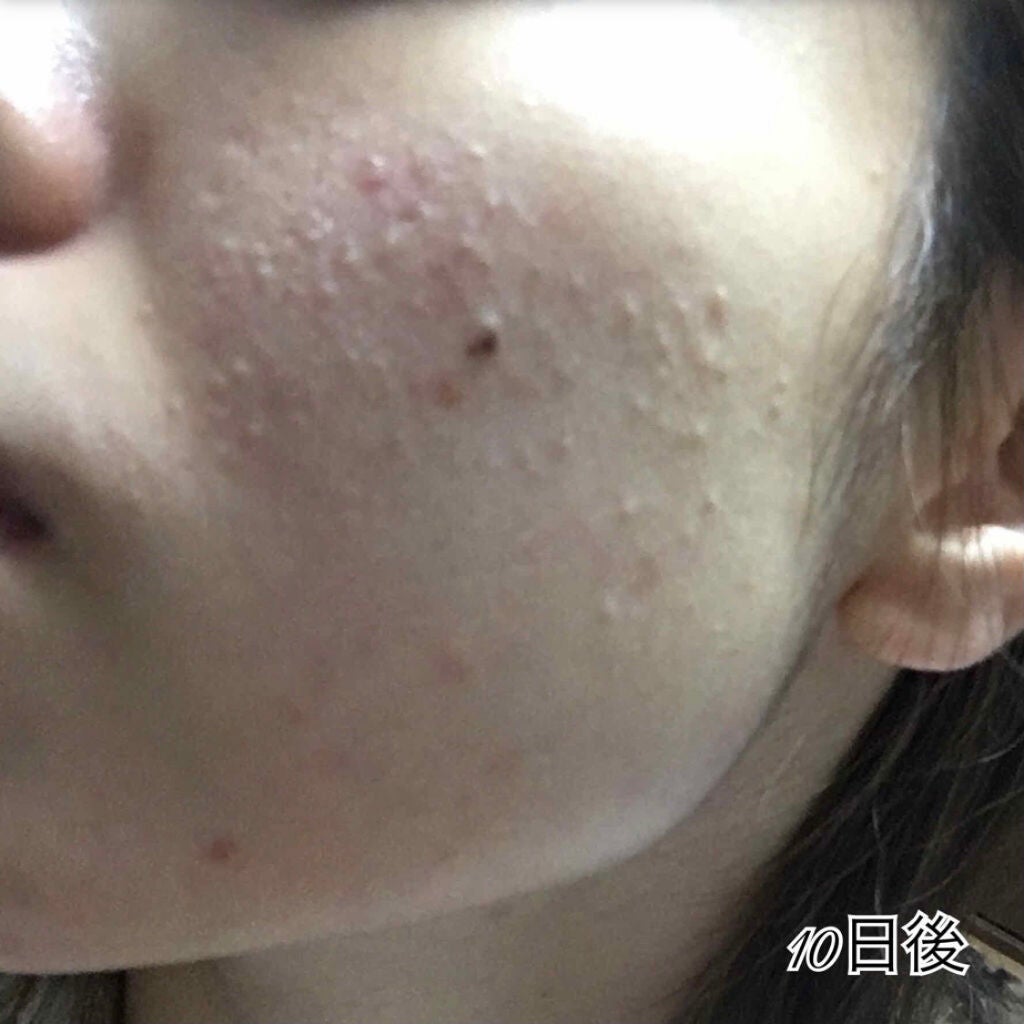 A アクネフォーム/NOV/洗顔フォームを使ったクチコミ(3枚目)