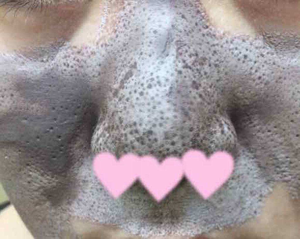 ツルリ 皮脂吸い出し 部分用パック ガスール&レッドパワー/ツルリ/洗い流すパック・マスクを使ったクチコミ(2枚目)