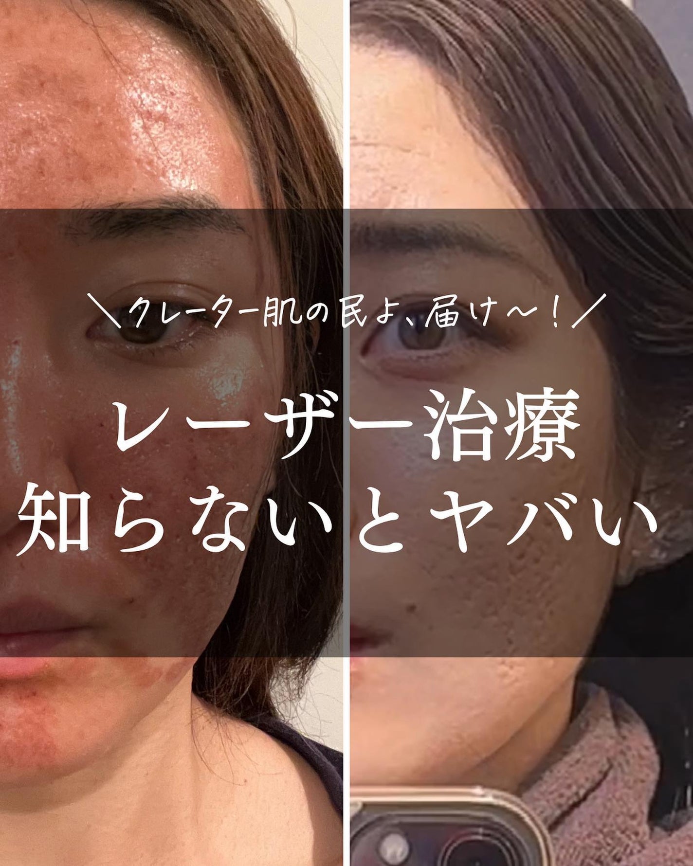 おゆみ|ニキビ・ニキビ跡ケア on LIPS 「【クレーター治療の基本のキ】こんばんは、おゆみです✨クレーター..」(1枚目)