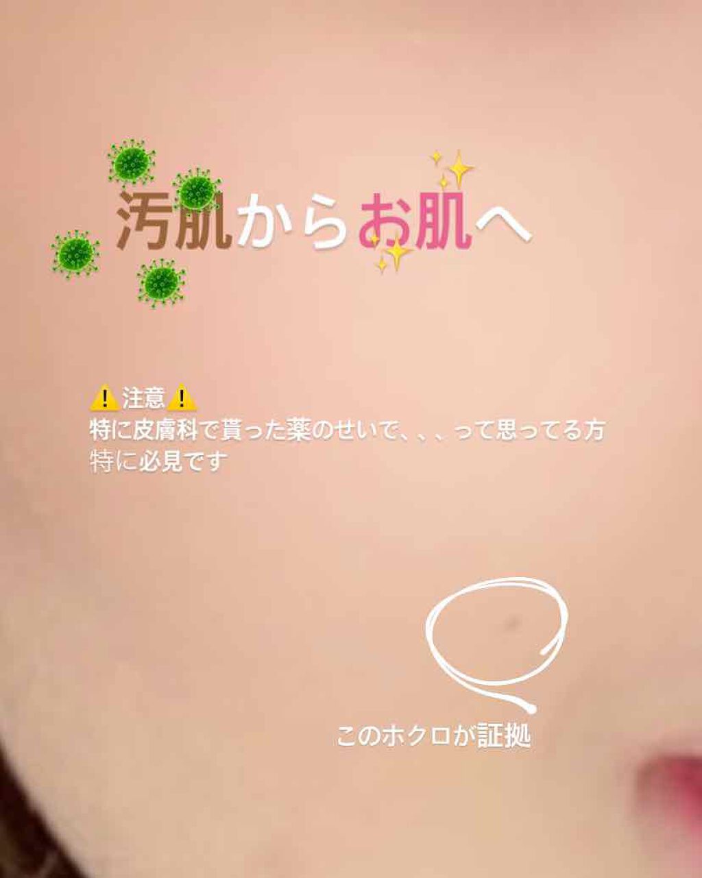 ロゼット洗顔パスタ アクネクリア/ロゼット/洗顔フォームを使ったクチコミ(1枚目)