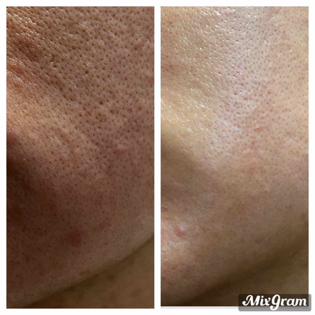 はだにゆめ on LIPS 「※注意⚠4枚目に汚肌あり。肌が汚すぎて、かの有名なb-glen..」(2枚目)