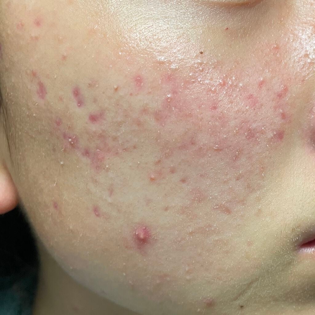 プラス on LIPS 「ニキビ日記..」(2枚目)