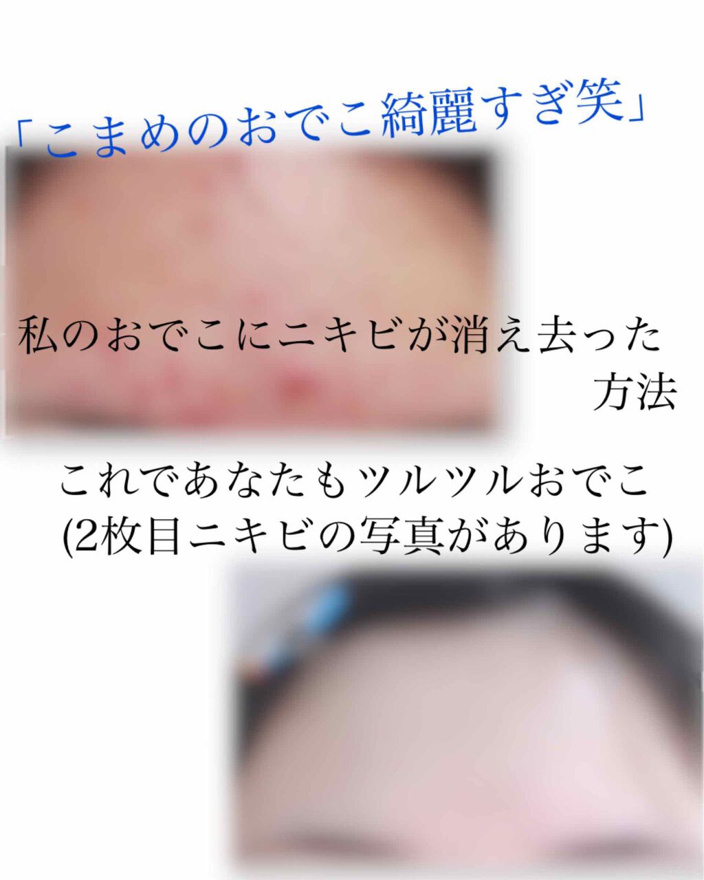 A アクネフォーム/NOV/洗顔フォームを使ったクチコミ（1枚目）