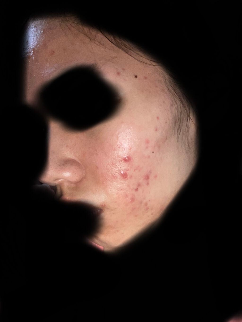 pink_sounds_rrza on LIPS 「汚すぎて無理肌荒れって何でこんな繰り返すん、べピオゲル使ってる..」(1枚目)