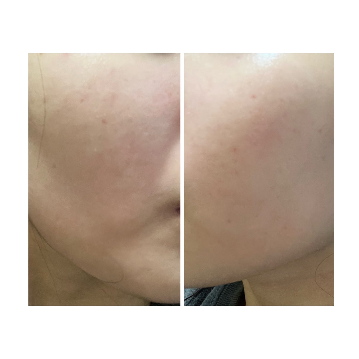 ぽむ on LIPS 「2023.9.13皮膚科に受診 エピデュオとヘパリン処方1枚目..」(3枚目)