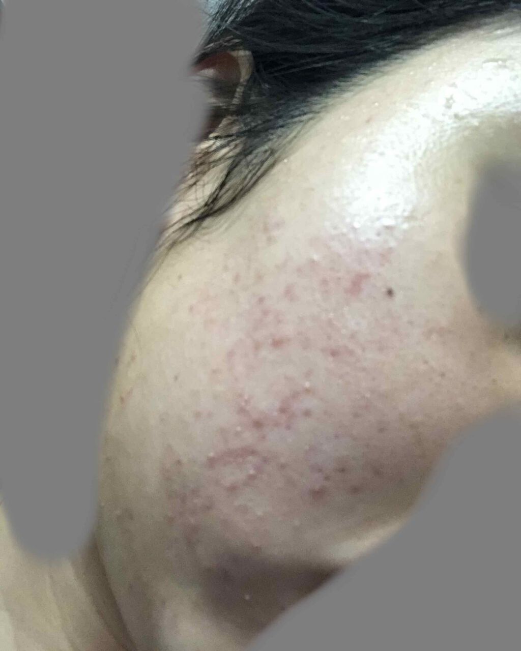 ベピオゲル/マルホ株式会社/その他を使ったクチコミ（3枚目）