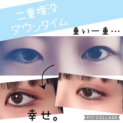 二重整形/その他を使ったクチコミ(1枚目)