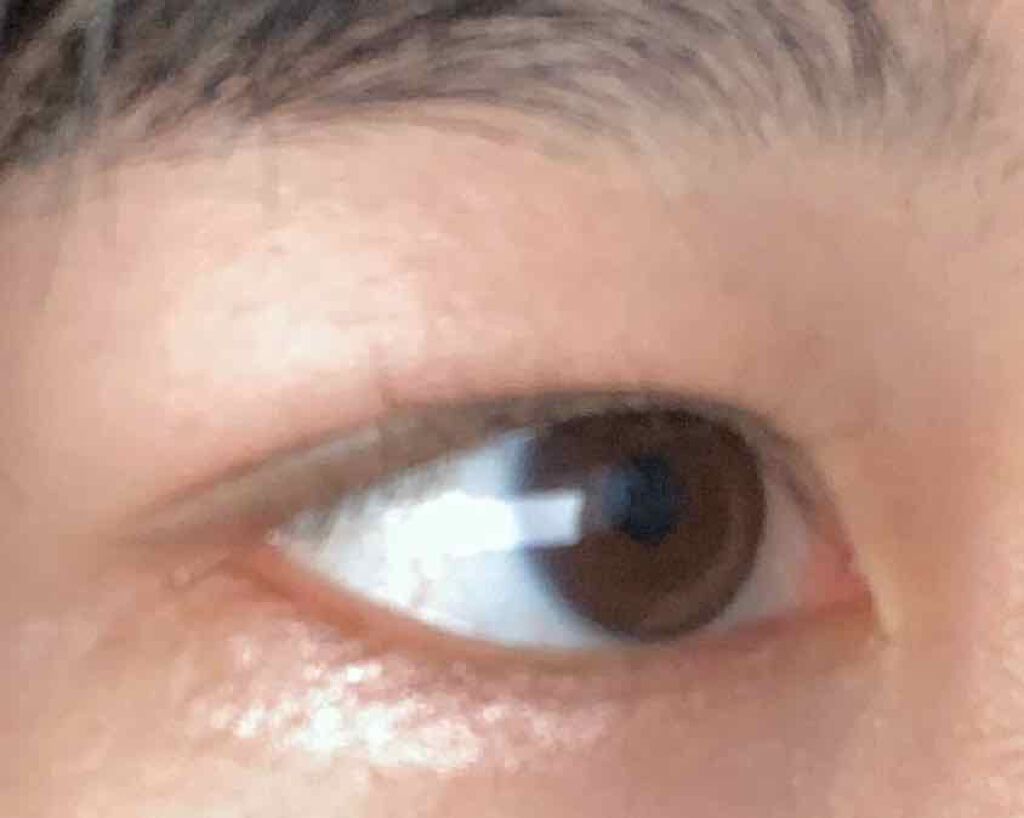 さな on LIPS 「二重整形して1日経ちました。正直違和感と突っ張る痛みはある。翌..」(1枚目)