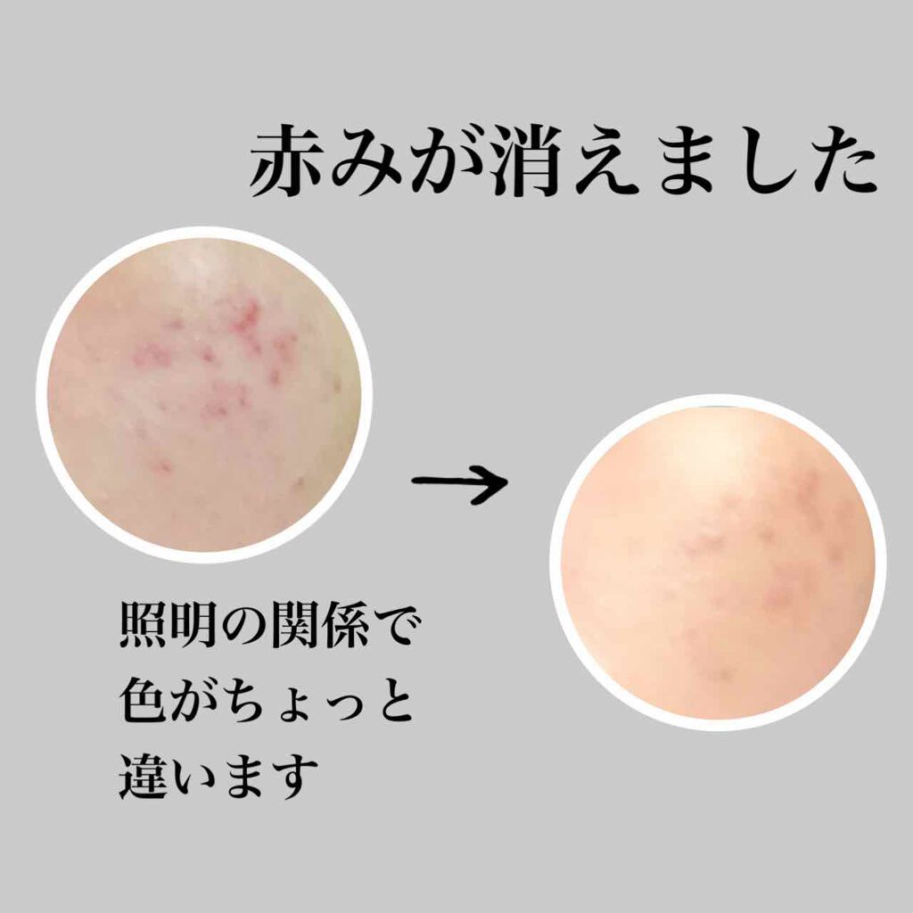 メンズアクネクリア 薬用コンシーラー ナチュラル/石澤研究所/スティックコンシーラーを使ったクチコミ(4枚目)