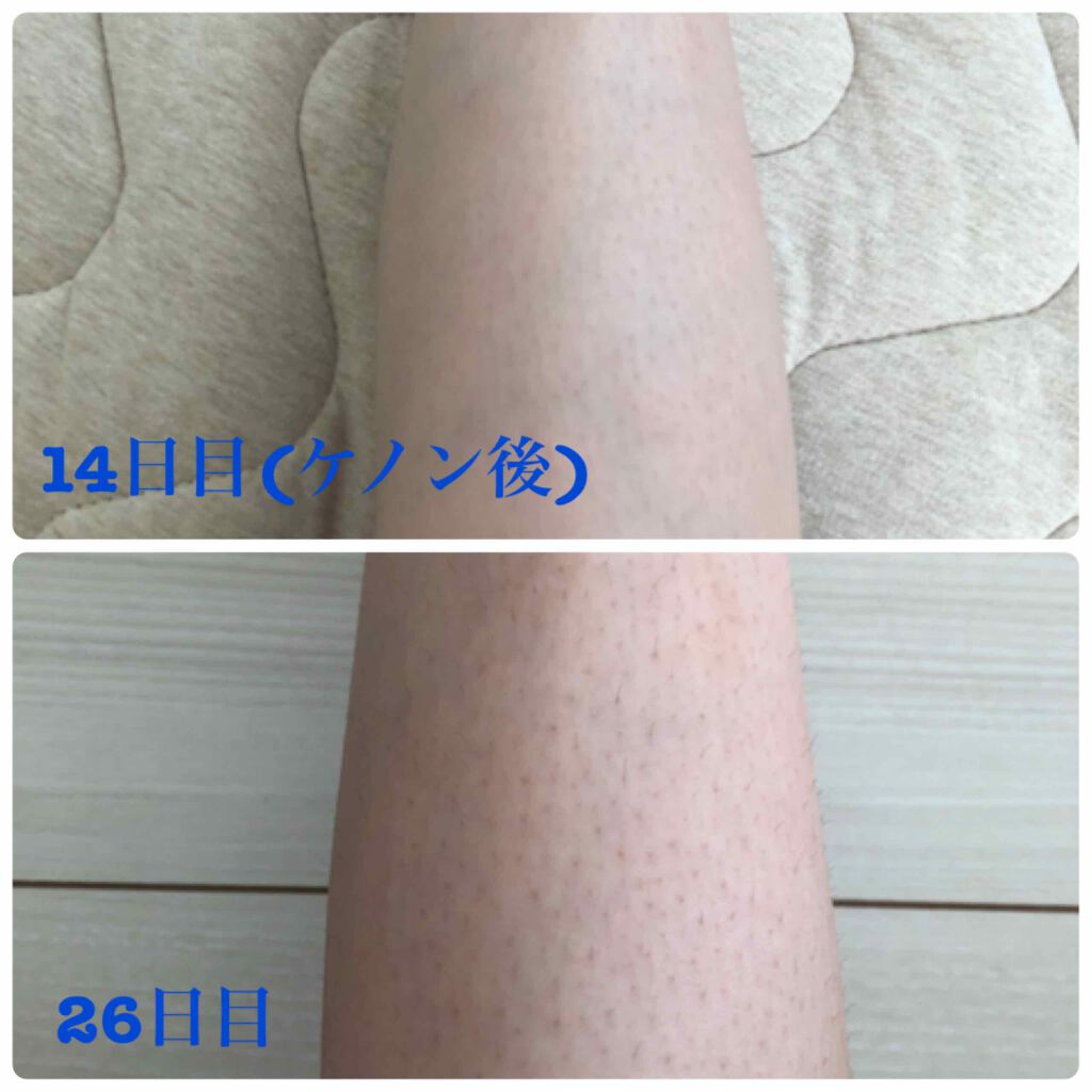 光美容器KE-NON(ケノン)/エムテック/家庭用脱毛器を使ったクチコミ(3枚目)