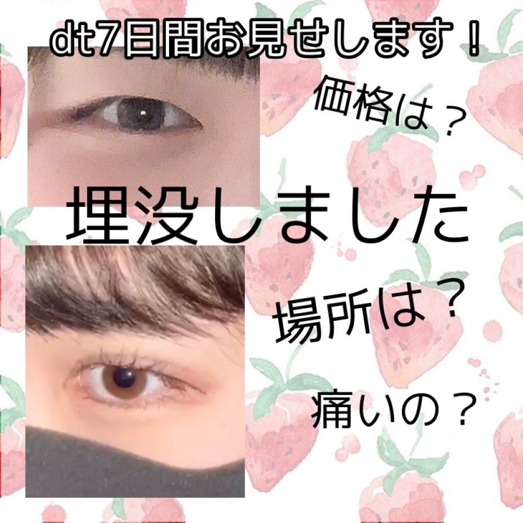 R@フォロバ100 on LIPS 「お久しぶりです!この度二重整形をして参りました!レポをしたいと..」(1枚目)