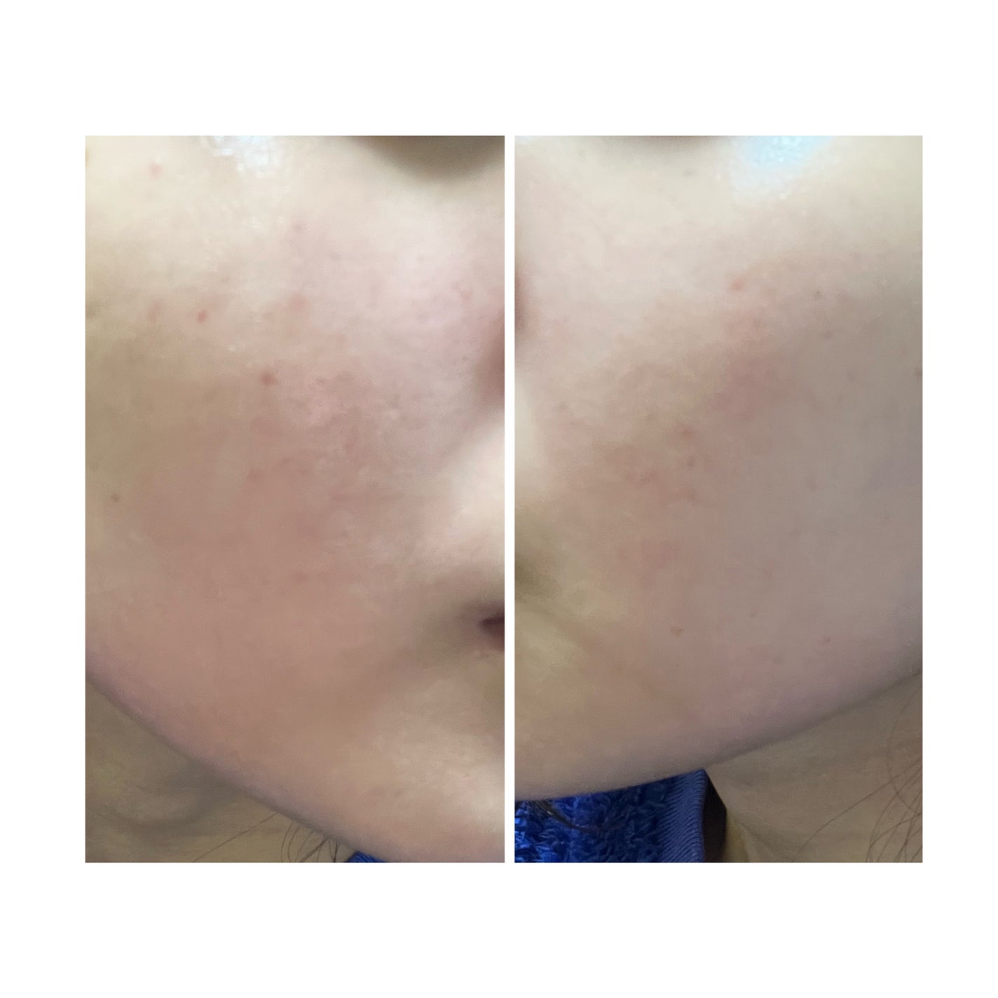 ぽむ on LIPS 「2023.9.13皮膚科に受診 エピデュオとヘパリン処方1枚目..」(4枚目)