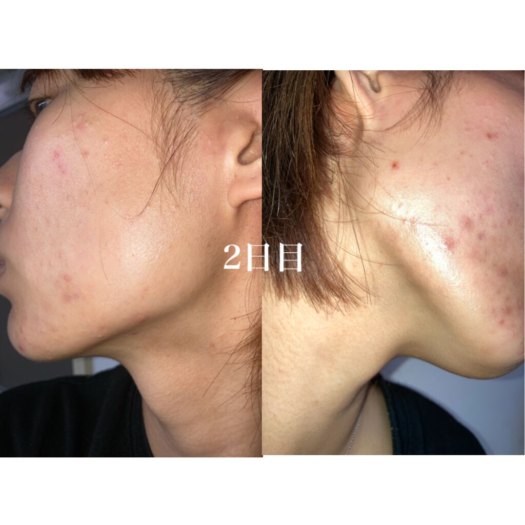 ペアアクネクリームW(医薬品)/ペア/その他を使ったクチコミ(1枚目)