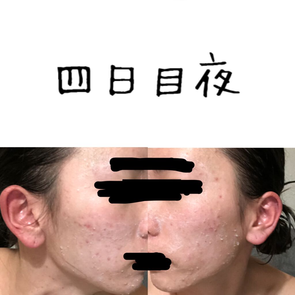 白潤 薬用美白化粧水/肌ラボ/化粧水を使ったクチコミ（1枚目）