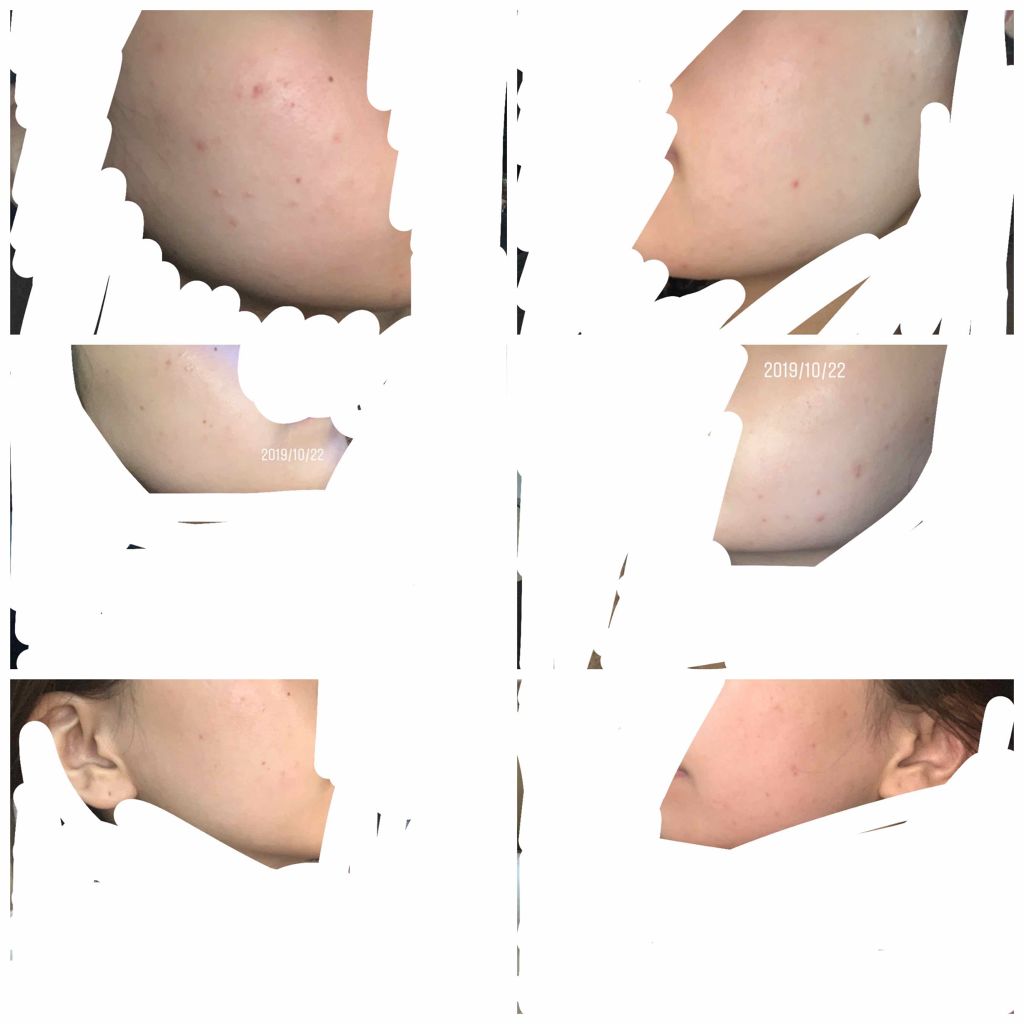 エピデュオゲル/マルホ株式会社/その他を使ったクチコミ（1枚目）