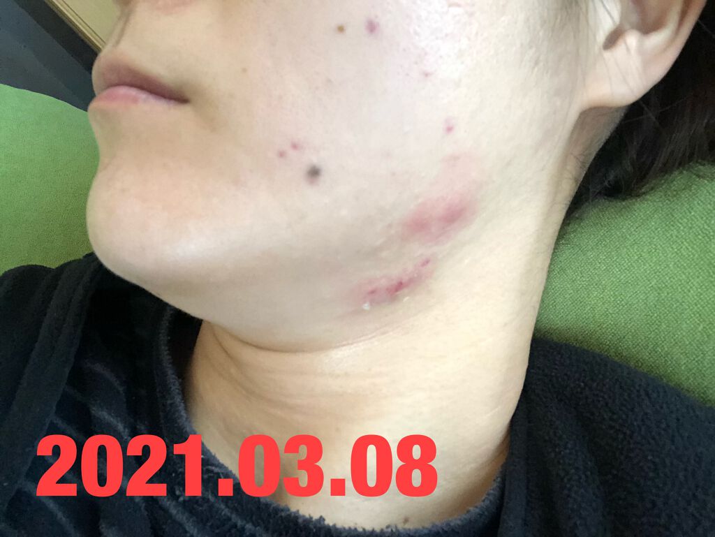 ライスフォース30日セット/ライスフォース/トライアルキットを使ったクチコミ（2枚目）