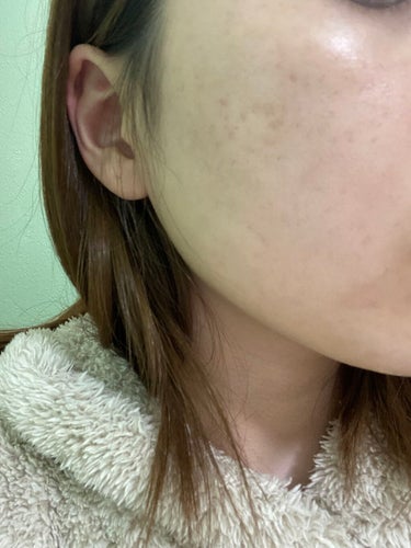 AHA 30% + BHA 2% Peeling Solution/The Ordinary/ピーリングを使ったクチコミ（2枚目）