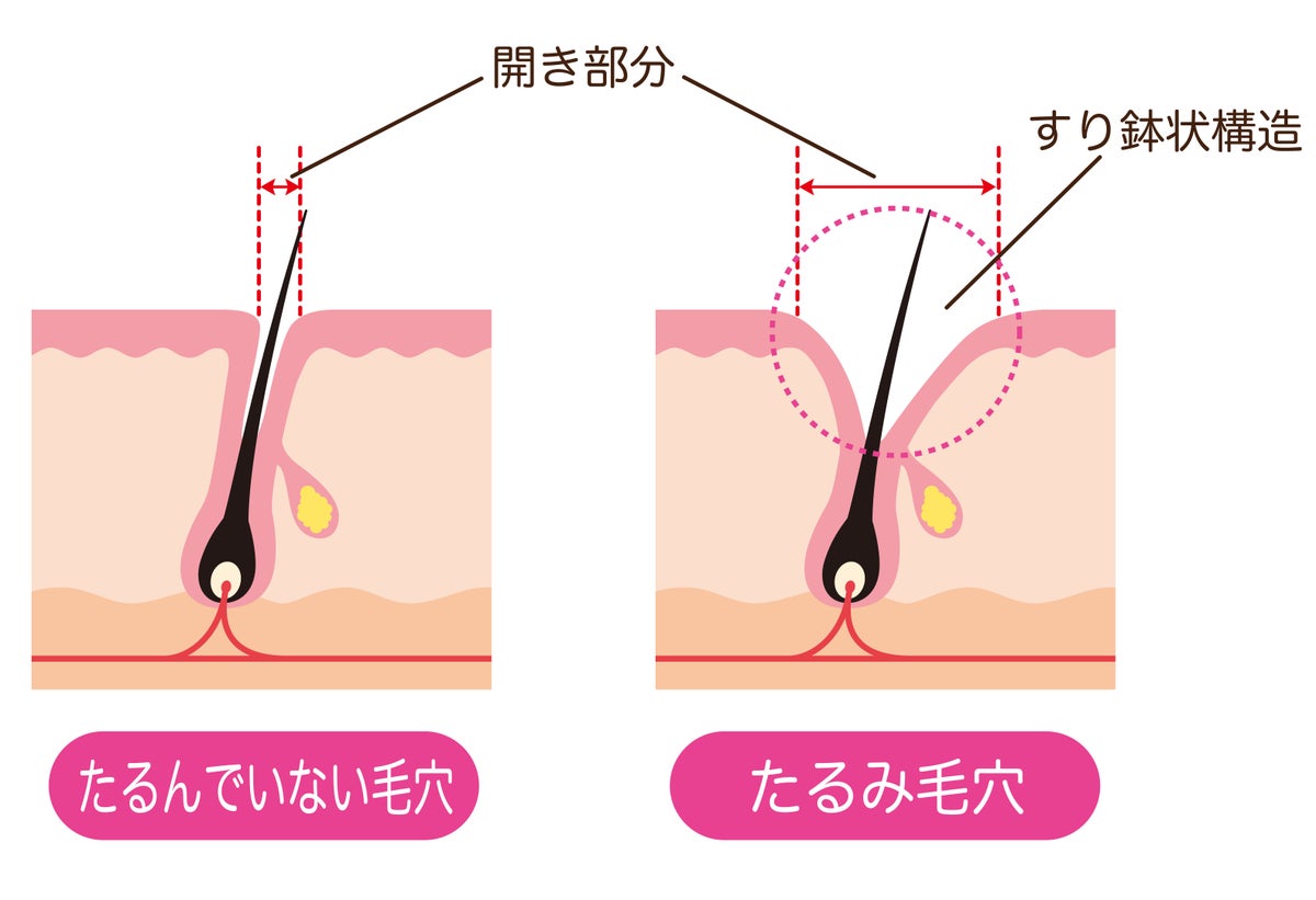 【黒ずみ汚れや角栓】小鼻の毛穴トラブルの原因と正しいケア方法は？おすすめアイテム20選も紹介の画像