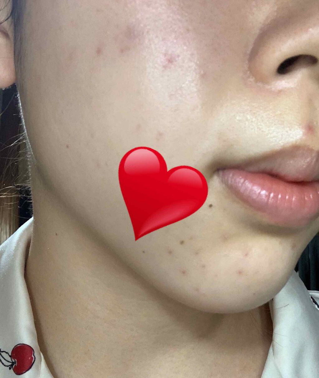 a on LIPS 「初投稿です!私は去年の11月ごろから突然大量の大人ニキビが発生..」(3枚目)