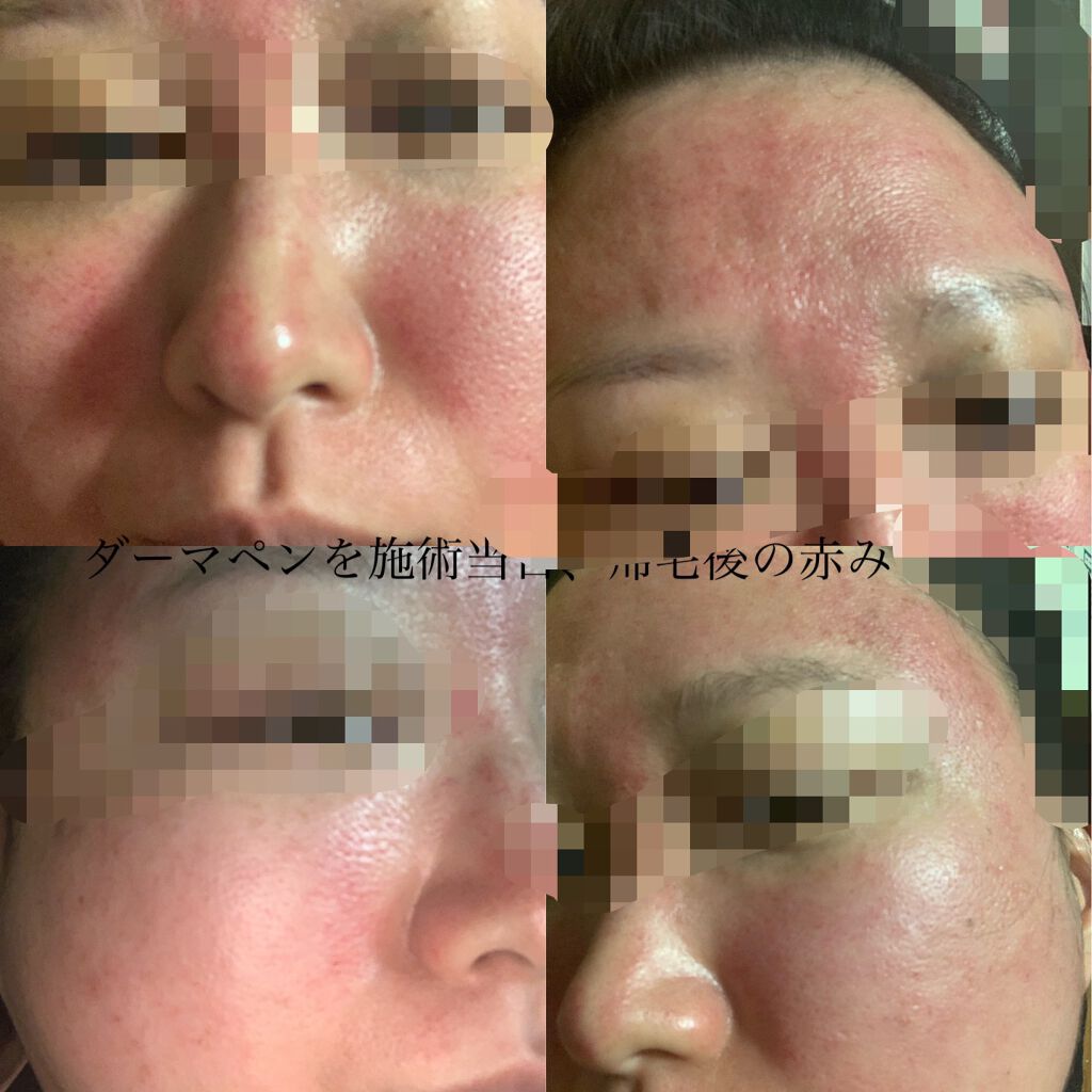 asu.fuji on LIPS 「初めてダーマペン4を土曜日に受けてきました。受けた目的は、オデ..」(3枚目)