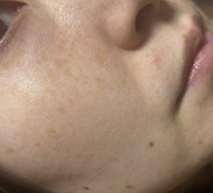 アゼペア 美容液/ネイチャーリパブリック/美容液を使ったクチコミ(5枚目)