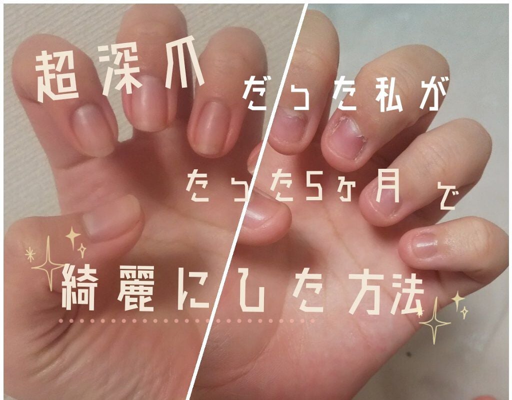 エテュセ クイックケアコート/ettusais/ネイルオイル・トリートメントを使ったクチコミ(1枚目)