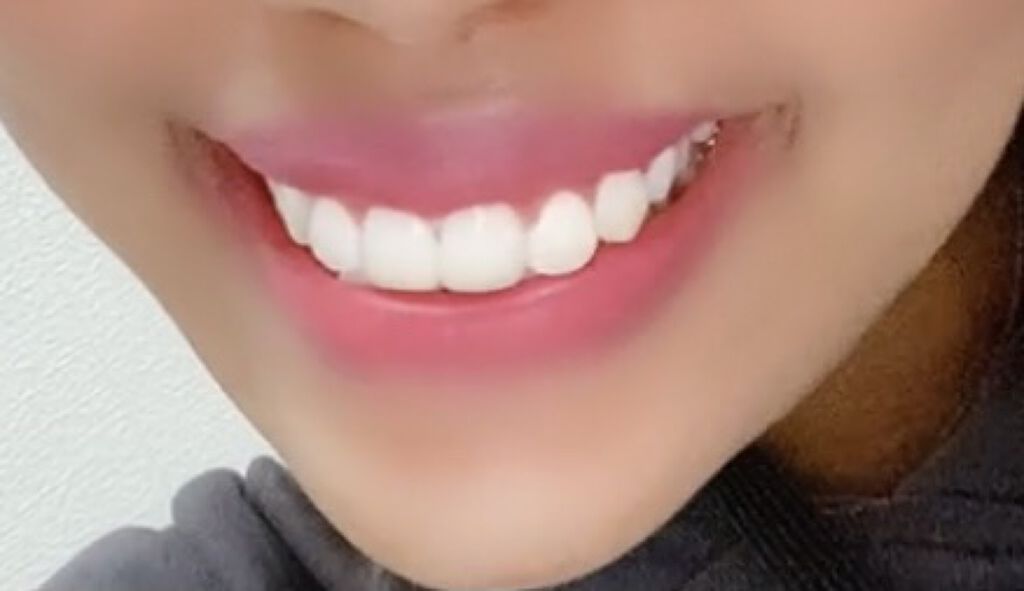 ジェルコートF/ウエルテック/その他オーラルケアを使ったクチコミ（2枚目）