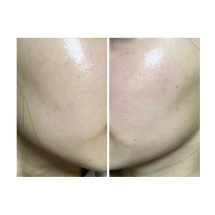 ぽむ on LIPS 「2023.9.13皮膚科に受診 エピデュオとヘパリン処方1枚目..」(2枚目)