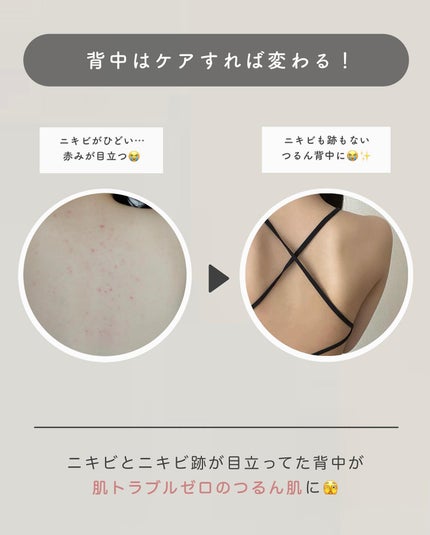 ニキビを防ぐ薬用石鹸 ForBack/ペリカン石鹸/ボディ石鹸を使ったクチコミ(2枚目)