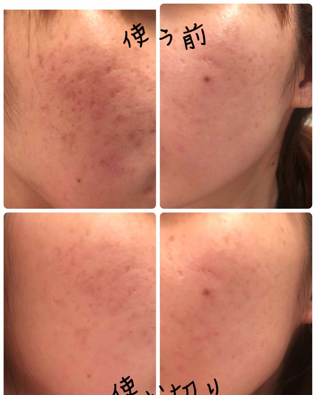 アクネケア おためしキット/ファンケル/トライアルキットを使ったクチコミ(2枚目)