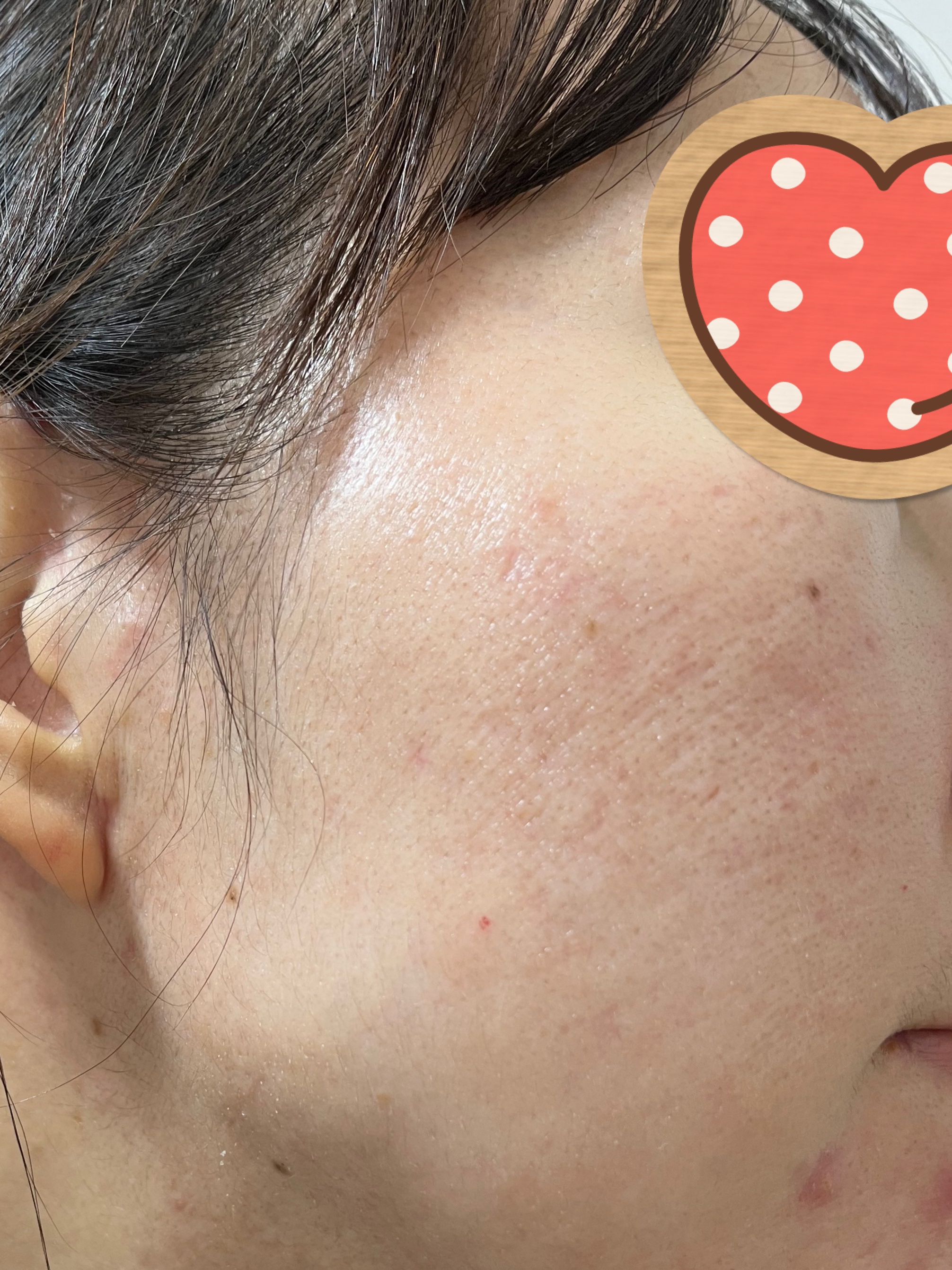 リードルショット300/VT/美容液を使ったクチコミ（2枚目）