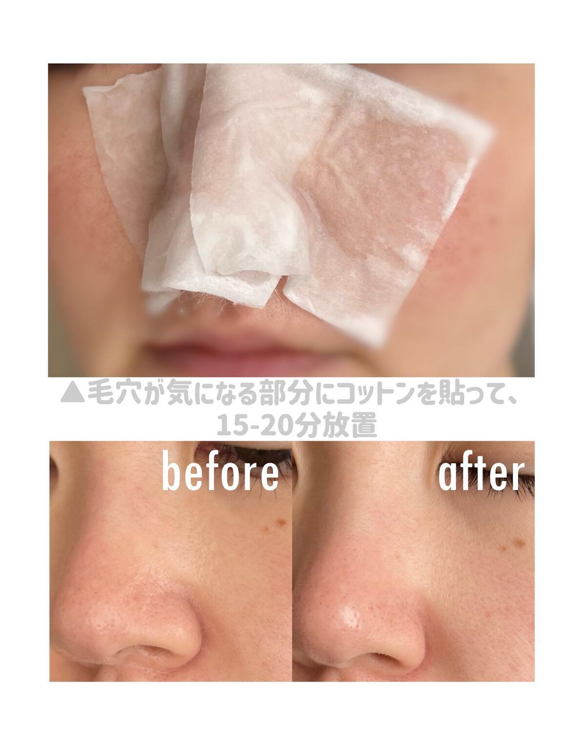 アクレオンセボエクストラクター/ANACIS/その他スキンケアを使ったクチコミ(3枚目)