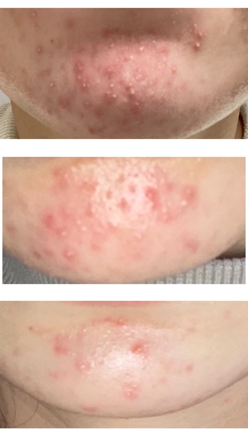 オードムーゲ 薬用ローション（ふきとり化粧水）/オードムーゲ/拭き取り化粧水を使ったクチコミ（3枚目）