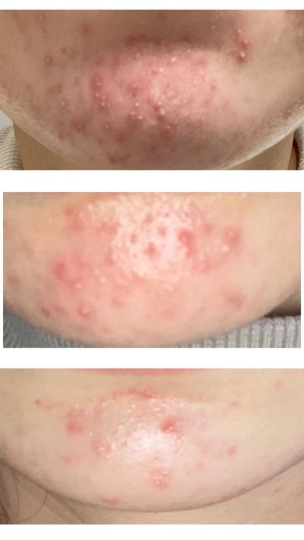 オードムーゲ 薬用ローション(ふきとり化粧水)/オードムーゲ/拭き取り化粧水を使ったクチコミ(3枚目)