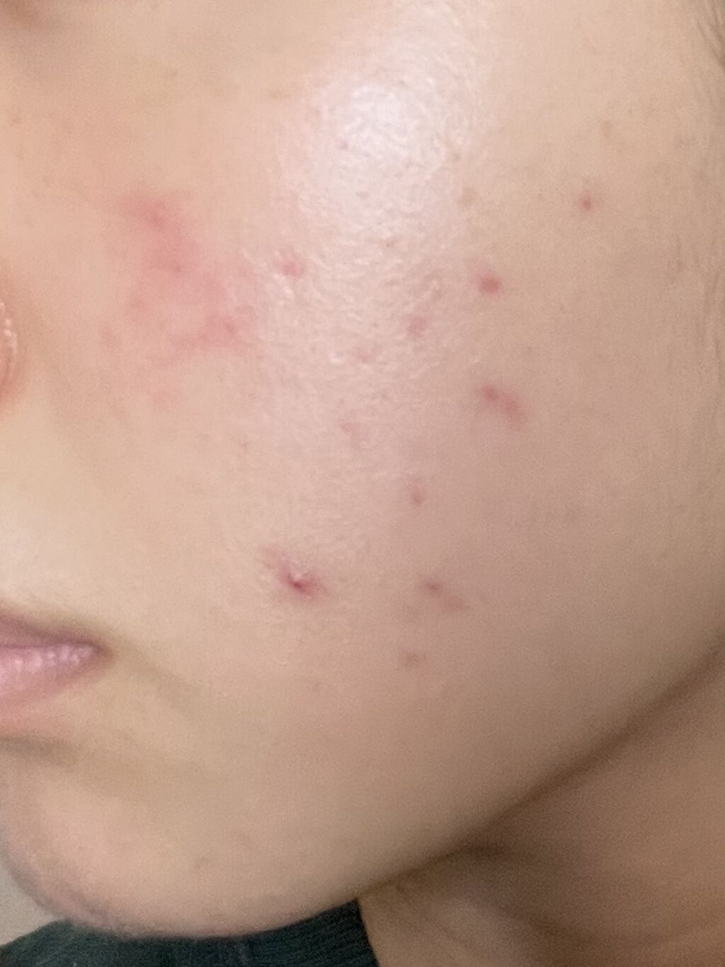 A アクネフォーム/NOV/洗顔フォームを使ったクチコミ（2枚目）