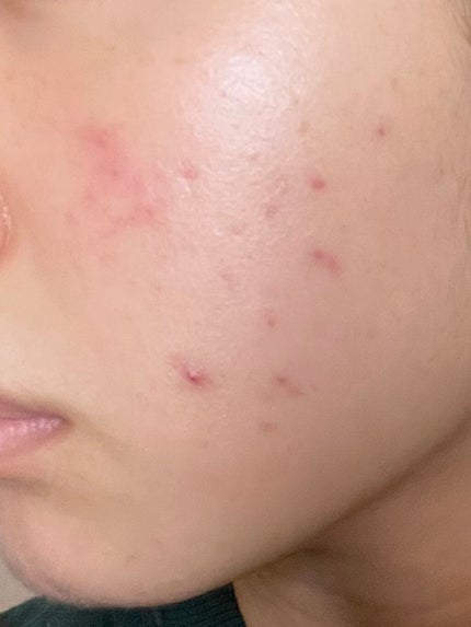 A アクネフォーム/NOV/洗顔フォームを使ったクチコミ(2枚目)