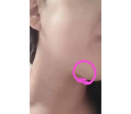 極薄透明パッチ nikipa!/金冠堂/にきびパッチを使ったクチコミ(4枚目)