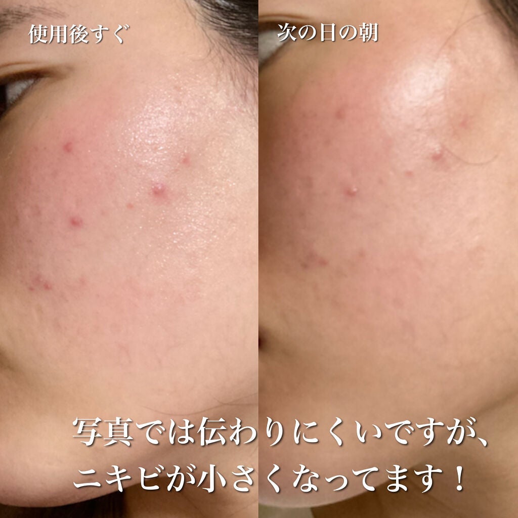 ティーツリーケアソリューション アンプルマスクJEX/MEDIHEAL/シートマスク・パックを使ったクチコミ(5枚目)
