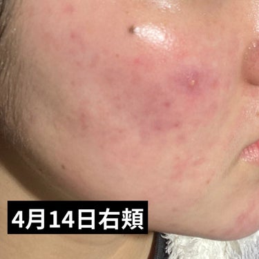 きちぽん on LIPS 「皮膚科でもらう薬を使ってから3ヶ月が経ちました！その経過が写真..」（3枚目）