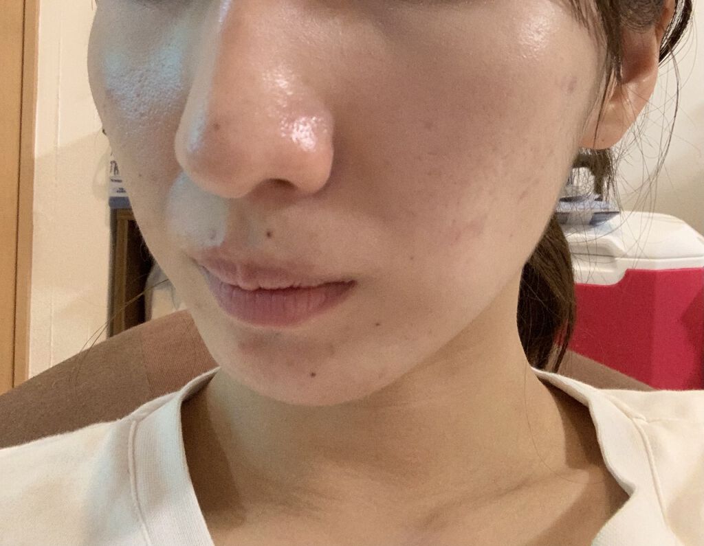 VC100エッセンスローション EX/ドクターシーラボⓇ/化粧水を使ったクチコミ（3枚目）